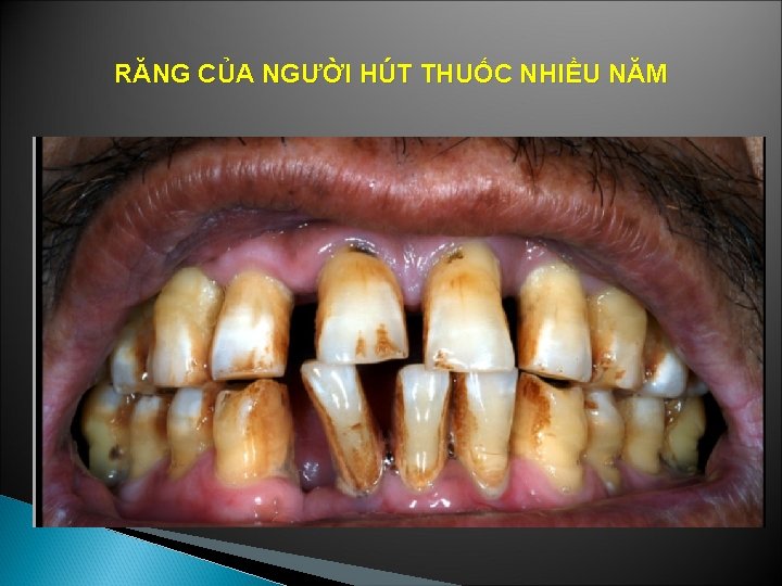 RĂNG CỦA NGƯỜI HÚT THUỐC NHIỀU NĂM 