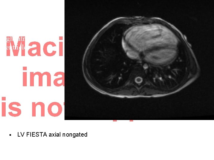 Moderately to severely dilated right atrium and ventricle. § LV FIESTA axial nongated 