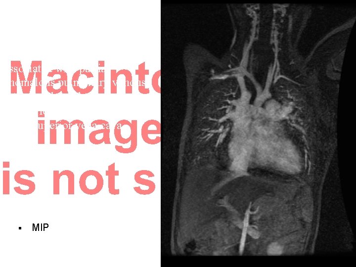 Sinus venosus septal defect associated with partial anomalous pulmonary venous return of the right Sinus venosus septal defect associated with partial anomalous pulmonary venous return of the right