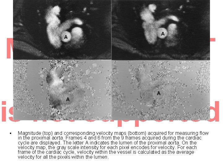 § Magnitude (top) and corresponding velocity maps (bottom) acquired for measuring flow in the § Magnitude (top) and corresponding velocity maps (bottom) acquired for measuring flow in the