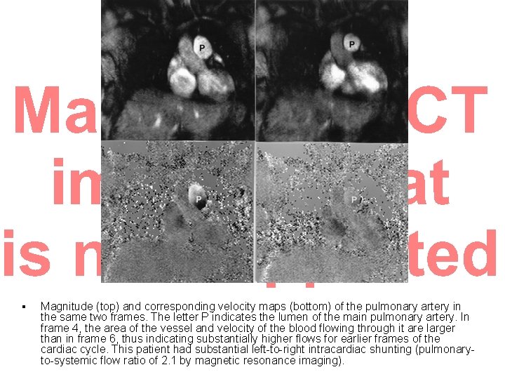 § Magnitude (top) and corresponding velocity maps (bottom) of the pulmonary artery in the