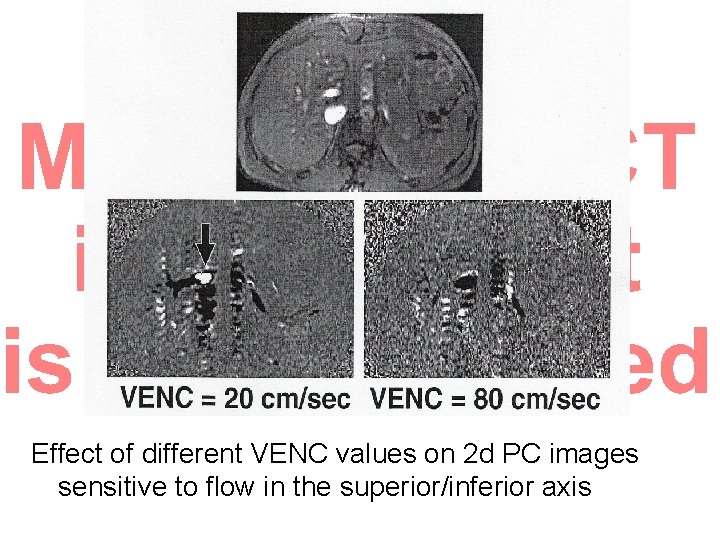 Effect of different VENC values on 2 d PC images sensitive to flow in Effect of different VENC values on 2 d PC images sensitive to flow in