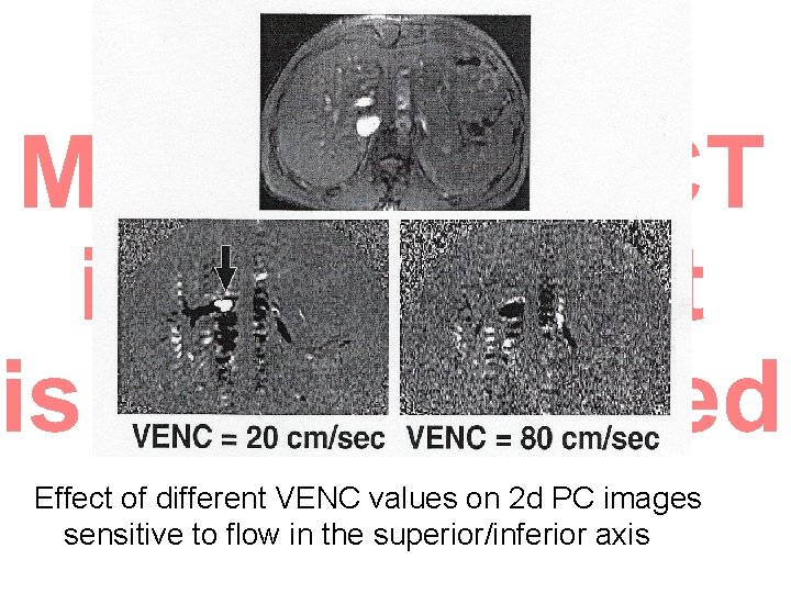 Effect of different VENC values on 2 d PC images sensitive to flow in