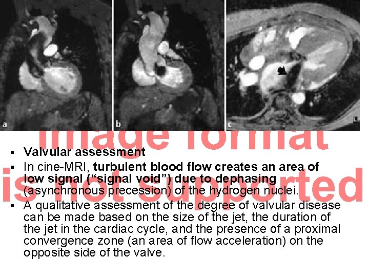 Valvular assessment In cine-MRI, turbulent blood flow creates an area of low signal (“signal Valvular assessment In cine-MRI, turbulent blood flow creates an area of low signal (“signal