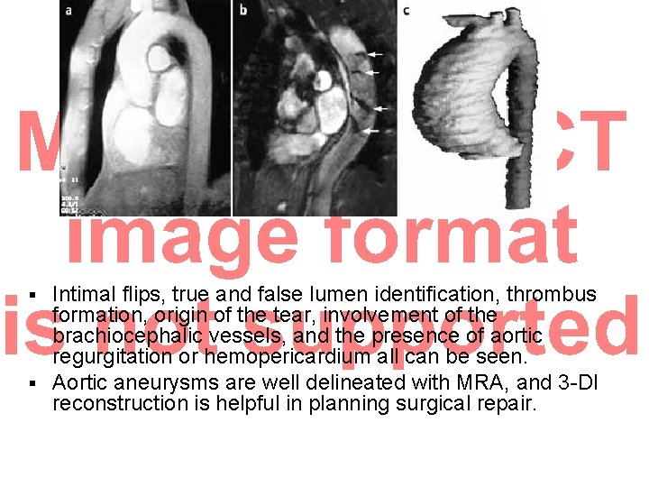 Intimal flips, true and false lumen identification, thrombus formation, origin of the tear, involvement Intimal flips, true and false lumen identification, thrombus formation, origin of the tear, involvement