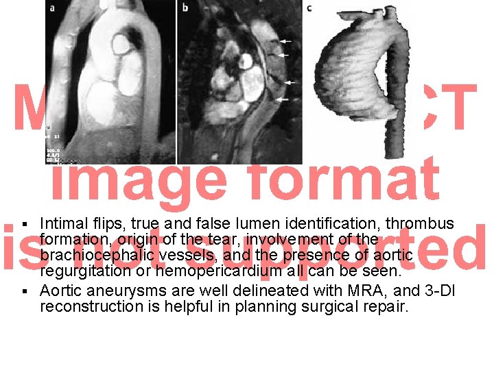 Intimal flips, true and false lumen identification, thrombus formation, origin of the tear, involvement