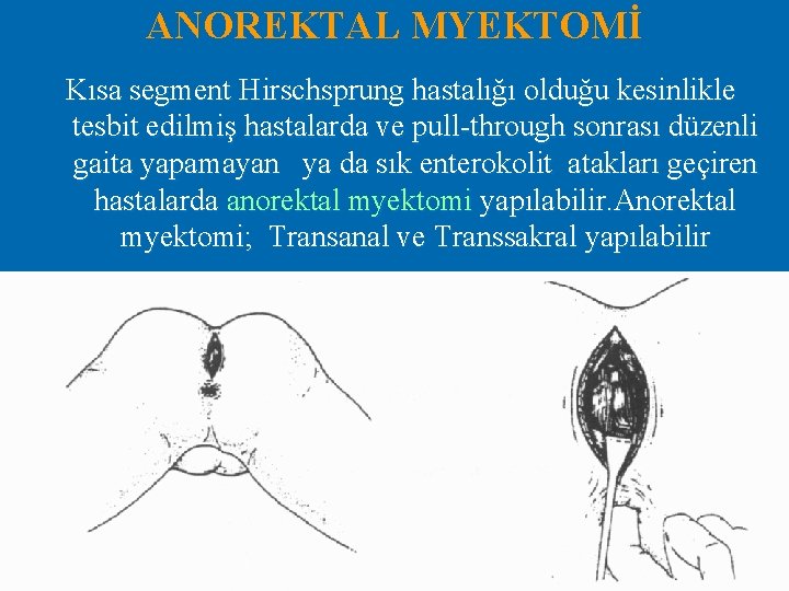 ANOREKTAL MYEKTOMİ Kısa segment Hirschsprung hastalığı olduğu kesinlikle tesbit edilmiş hastalarda ve pull-through sonrası