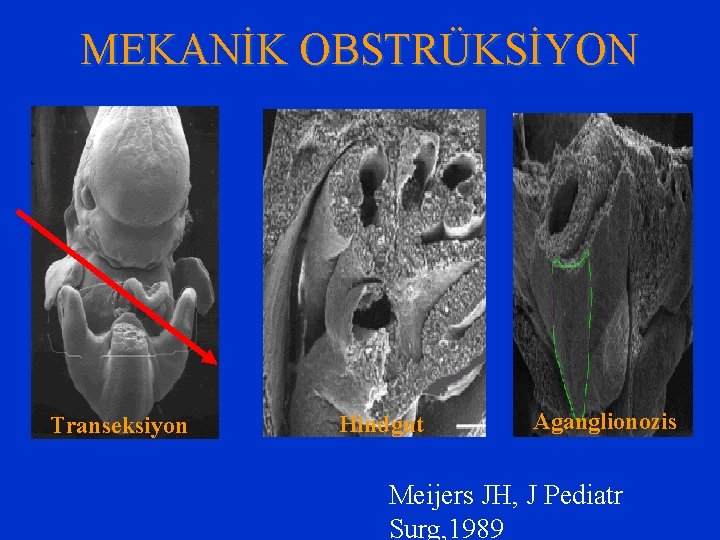 MEKANİK OBSTRÜKSİYON Transeksiyon Hindgut Aganglionozis Meijers JH, J Pediatr Surg, 1989 