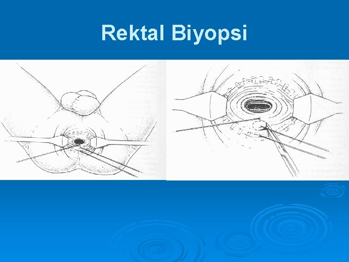 Rektal Biyopsi 