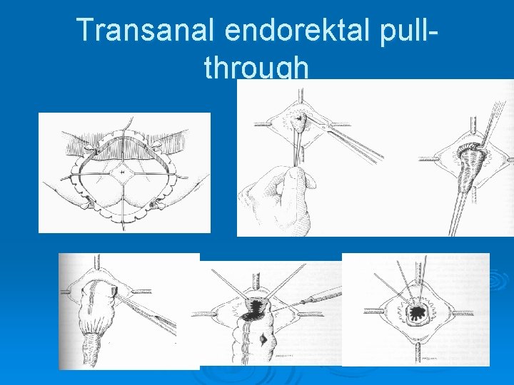 Transanal endorektal pullthrough 