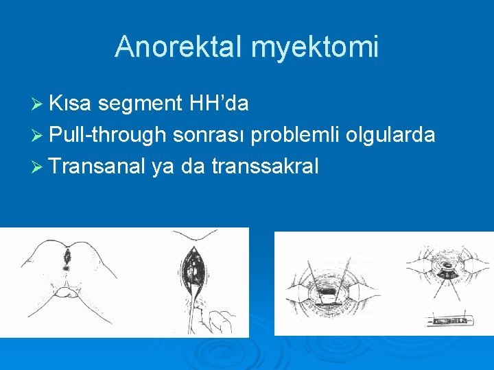 Anorektal myektomi Ø Kısa segment HH’da Ø Pull-through sonrası problemli olgularda Ø Transanal ya