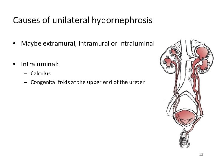 Causes of unilateral hydornephrosis • Maybe extramural, intramural or Intraluminal • Intraluminal: – Calculus