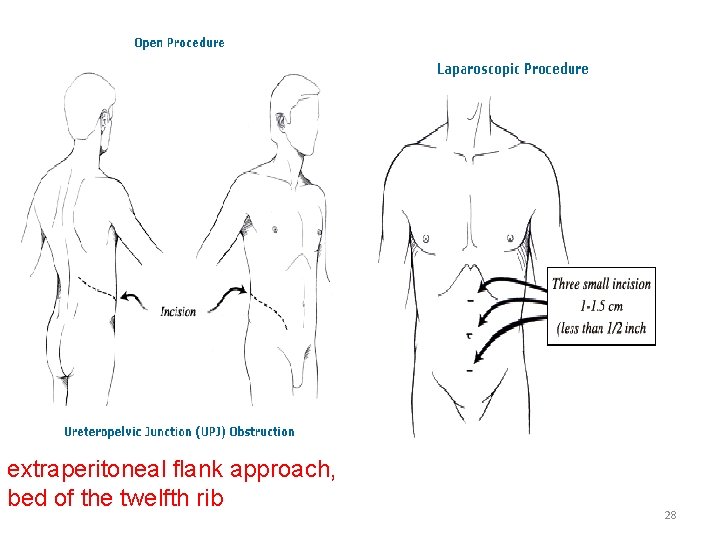 extraperitoneal flank approach, bed of the twelfth rib 28 