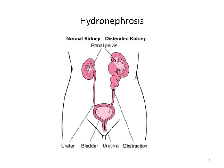 Hydronephrosis 4 