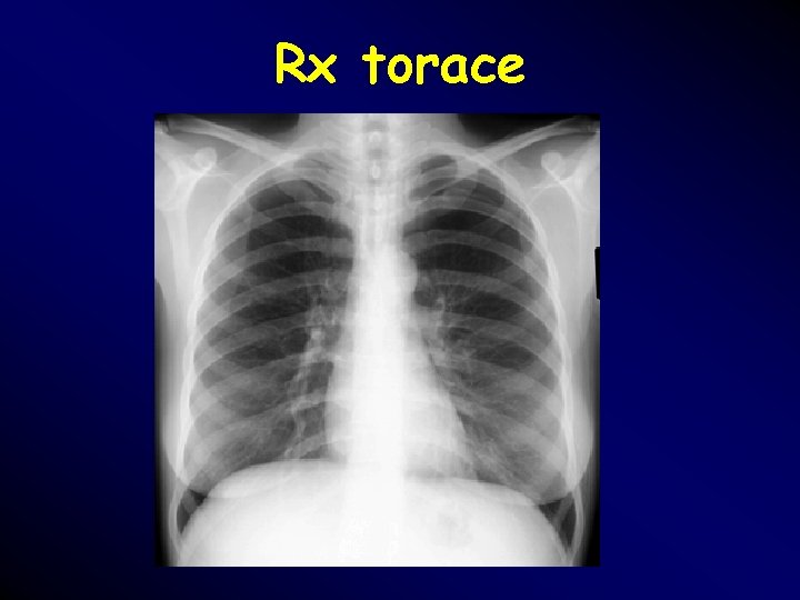 Rx torace Rx torace