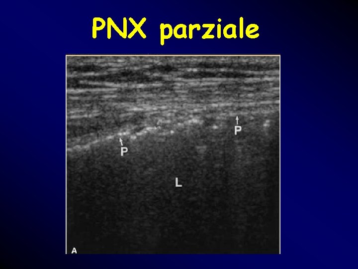 PNX parziale PNX parziale