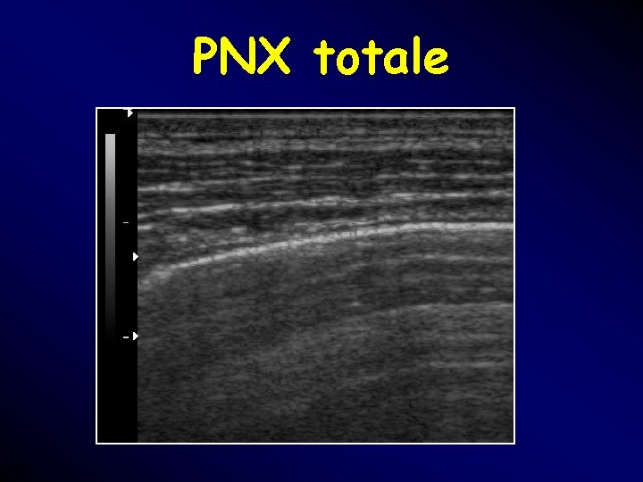 PNX totale PNX totale