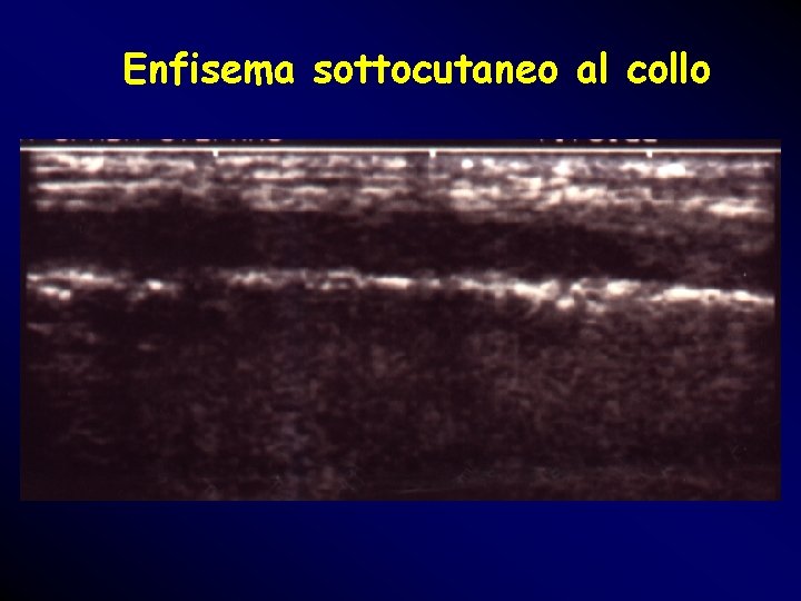 Enfisema sottocutaneo al collo Enfisema sottocutaneo al collo