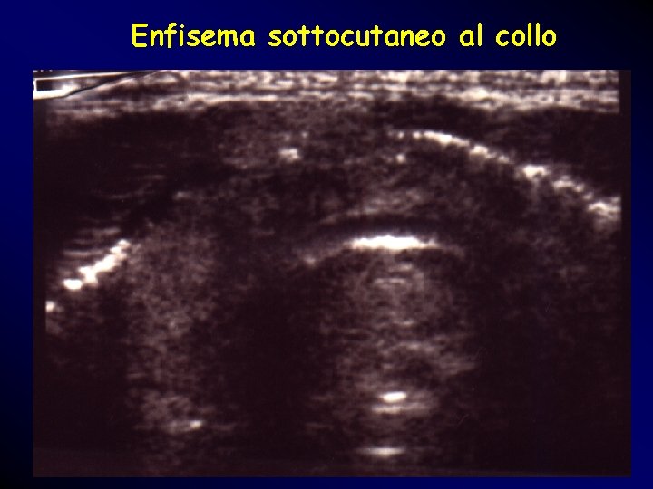 Enfisema sottocutaneo al collo Enfisema sottocutaneo al collo