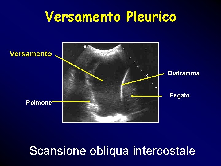 Versamento Pleurico Versamento Diaframma Fegato Polmone Scansione obliqua intercostale Versamento Pleurico Versamento Diaframma Fegato Polmone Scansione obliqua intercostale