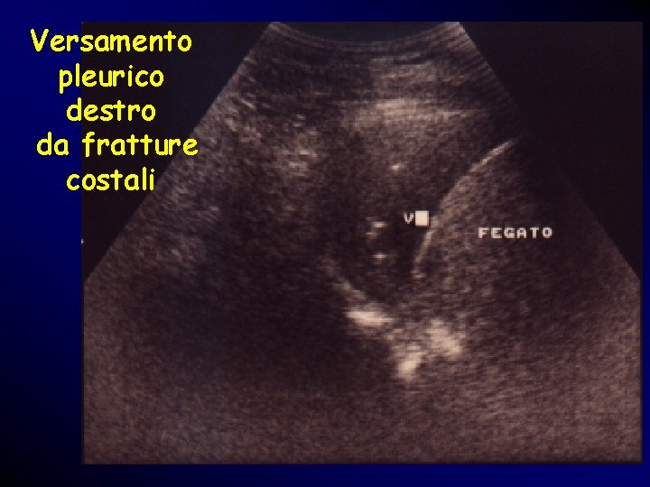 Versamento pleurico destro da fratture costali Versamento pleurico destro da fratture costali