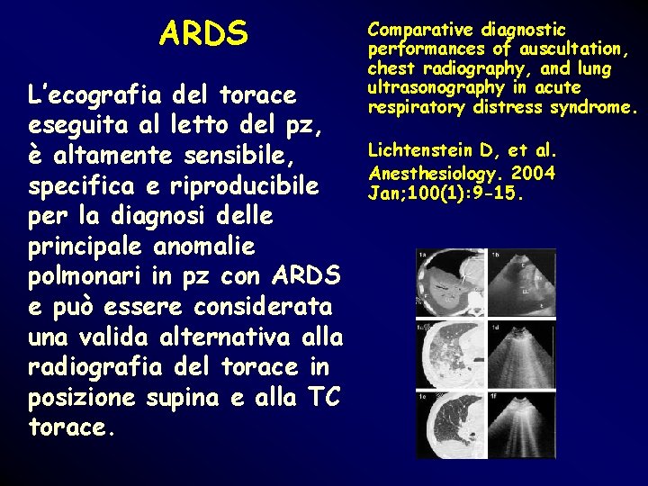 ARDS L’ecografia del torace eseguita al letto del pz, è altamente sensibile, specifica e ARDS L’ecografia del torace eseguita al letto del pz, è altamente sensibile, specifica e