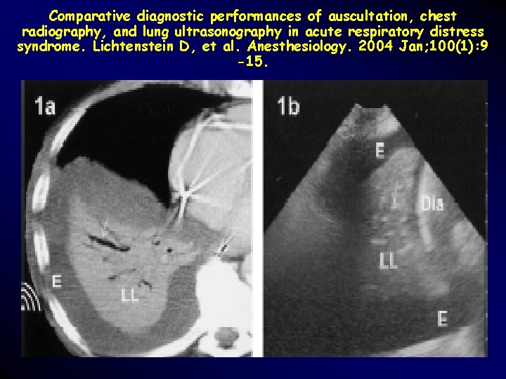 Comparative diagnostic performances of auscultation, chest radiography, and lung ultrasonography in acute respiratory distress Comparative diagnostic performances of auscultation, chest radiography, and lung ultrasonography in acute respiratory distress