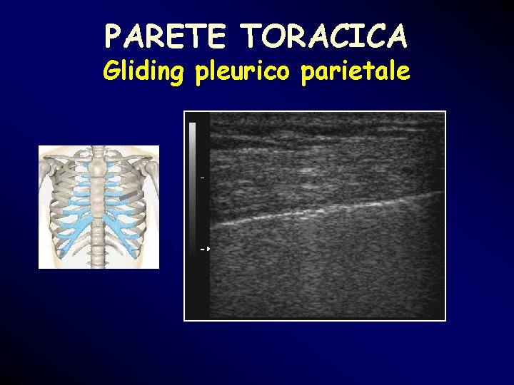 PARETE TORACICA Gliding pleurico parietale PARETE TORACICA Gliding pleurico parietale