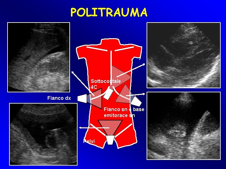 POLITRAUMA Sottocostale 4 C Fianco dx Fianco sn e base emitorace sn Pelvi POLITRAUMA Sottocostale 4 C Fianco dx Fianco sn e base emitorace sn Pelvi
