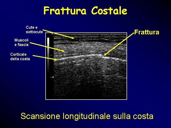 Frattura Costale Cute e sottocute Frattura Muscoli e fascia Corticale della costa Scansione longitudinale Frattura Costale Cute e sottocute Frattura Muscoli e fascia Corticale della costa Scansione longitudinale
