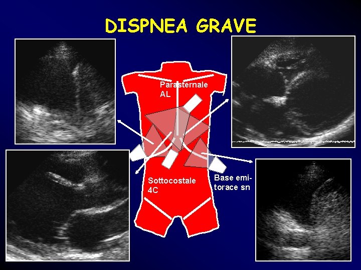 DISPNEA GRAVE Parasternale AL Base emitorace dx Sottocostale 4 C Base emitorace sn DISPNEA GRAVE Parasternale AL Base emitorace dx Sottocostale 4 C Base emitorace sn