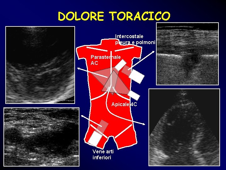 DOLORE TORACICO Intercostale pleura e polmoni Parasternale AC Apicale 4 C Vene arti inferiori DOLORE TORACICO Intercostale pleura e polmoni Parasternale AC Apicale 4 C Vene arti inferiori