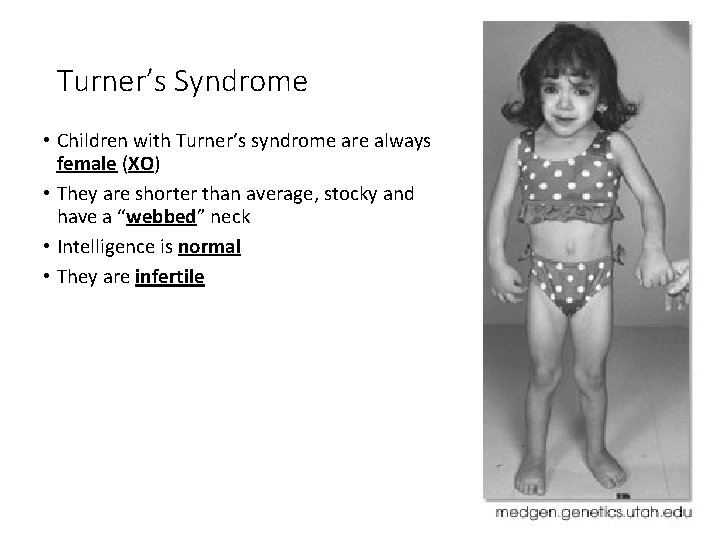 Turner’s Syndrome • Children with Turner’s syndrome are always female (XO) • They are