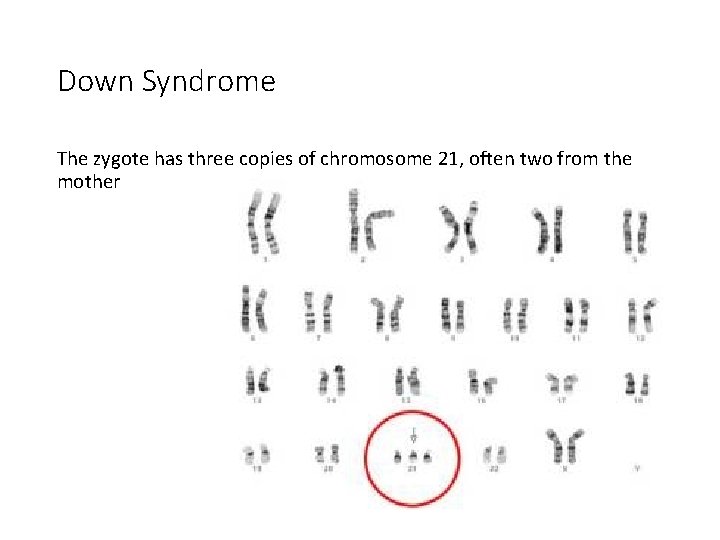 Down Syndrome The zygote has three copies of chromosome 21, often two from the