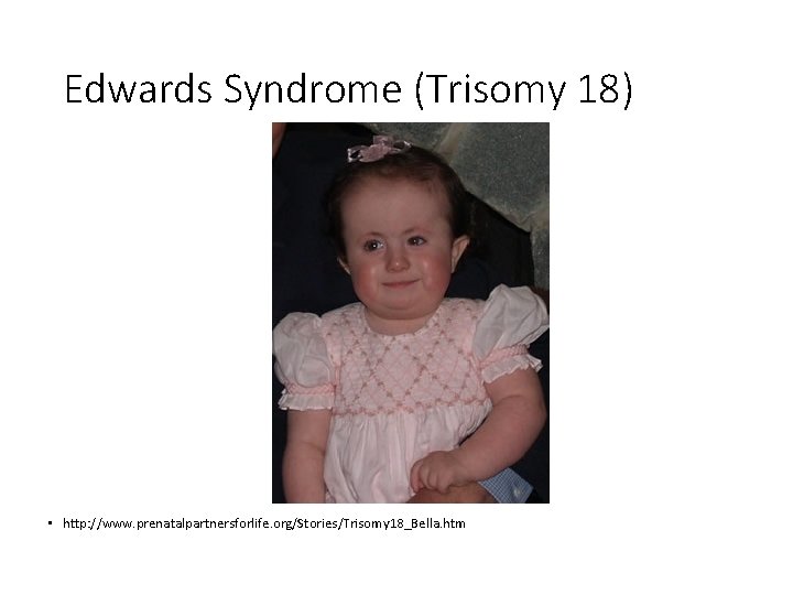 Edwards Syndrome (Trisomy 18) • http: //www. prenatalpartnersforlife. org/Stories/Trisomy 18_Bella. htm 