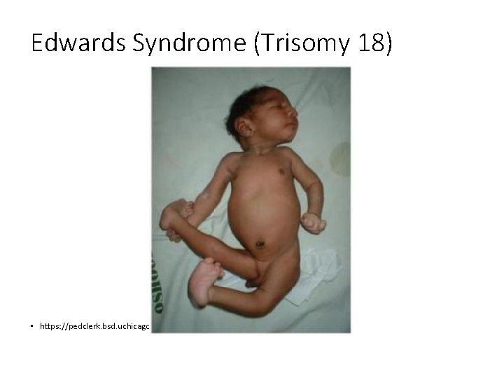 Edwards Syndrome (Trisomy 18) • https: //pedclerk. bsd. uchicago. edu/page/trisomy-18 -edwards-trisomy-13 -patau 