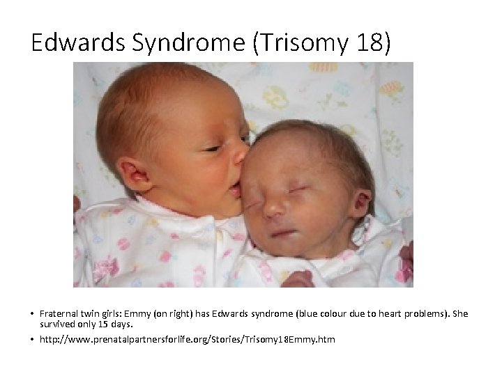 Edwards Syndrome (Trisomy 18) • Fraternal twin girls: Emmy (on right) has Edwards syndrome