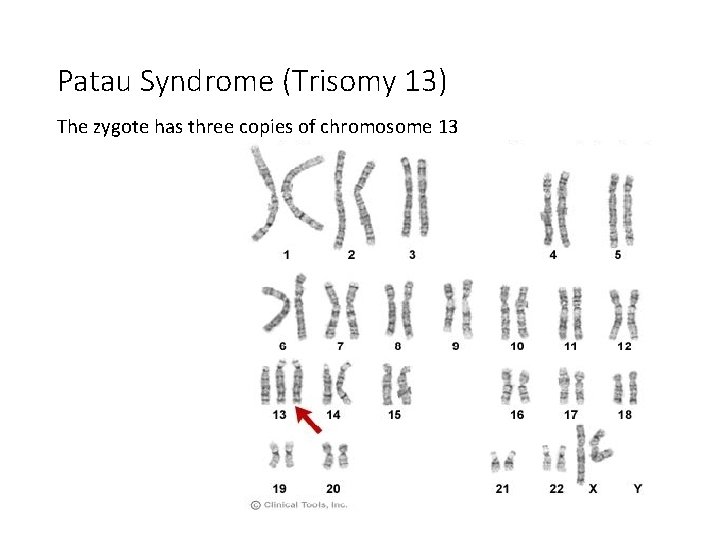 Patau Syndrome (Trisomy 13) The zygote has three copies of chromosome 13 