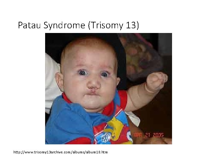 Patau Syndrome (Trisomy 13) http: //www. trisomy 13 archive. com/albums/album 18. htm 