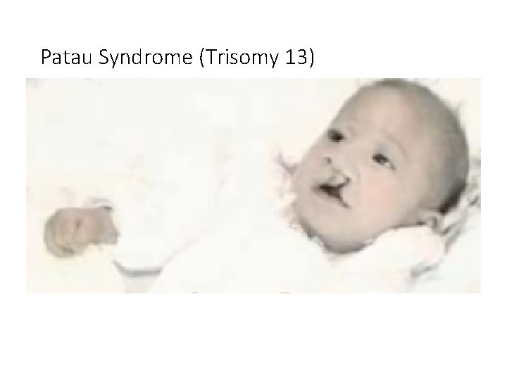 Patau Syndrome (Trisomy 13) • http: //symptomstreatment. org/patau-syndrome/ 