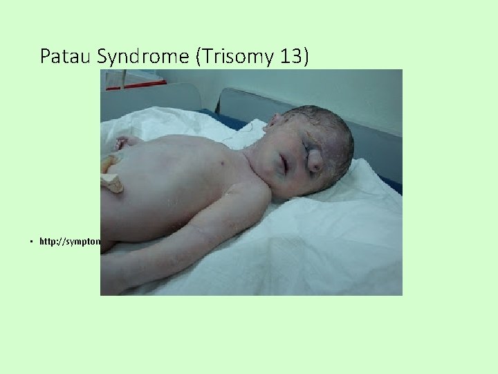 Patau Syndrome (Trisomy 13) • http: //symptomstreatment. org/patau-syndrome/ 