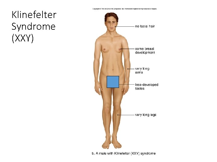 Klinefelter Syndrome (XXY) 