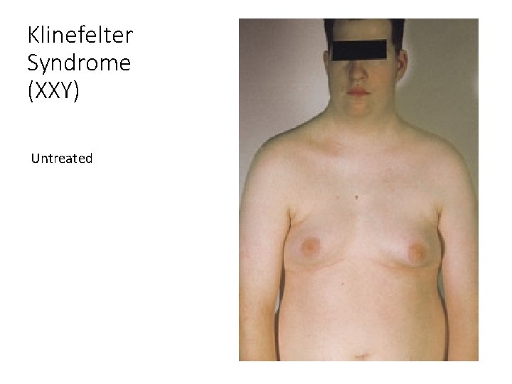 Klinefelter Syndrome (XXY) Untreated 