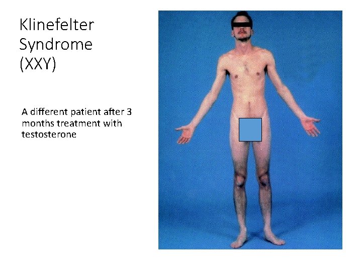 Klinefelter Syndrome (XXY) A different patient after 3 months treatment with testosterone 