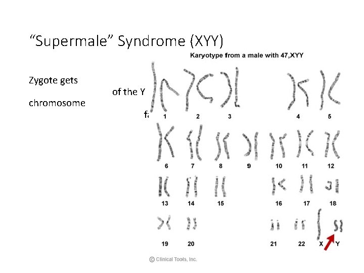 “Supermale” Syndrome (XYY) Zygote gets chromosome of the Y father two copies from the