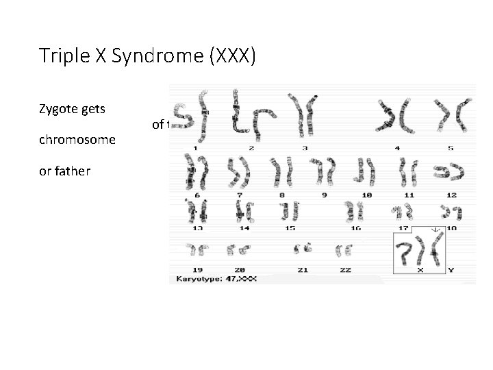 Triple X Syndrome (XXX) Zygote gets chromosome or father of the X the mother