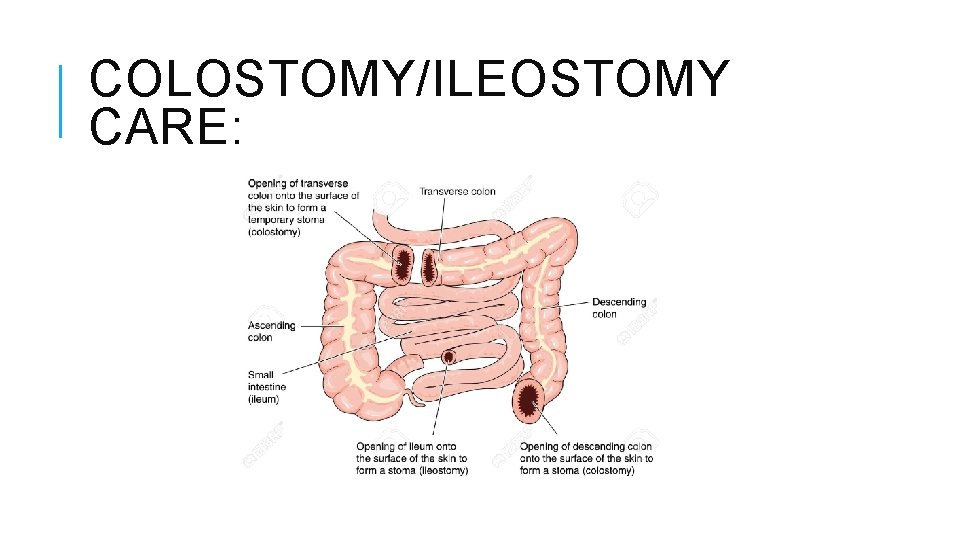 COLOSTOMY/ILEOSTOMY CARE: COLOSTOMY/ILEOSTOMY CARE: