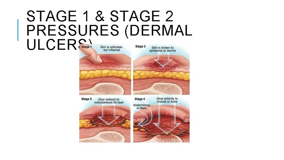 STAGE 1 & STAGE 2 PRESSURES (DERMAL ULCERS) STAGE 1 & STAGE 2 PRESSURES (DERMAL ULCERS)