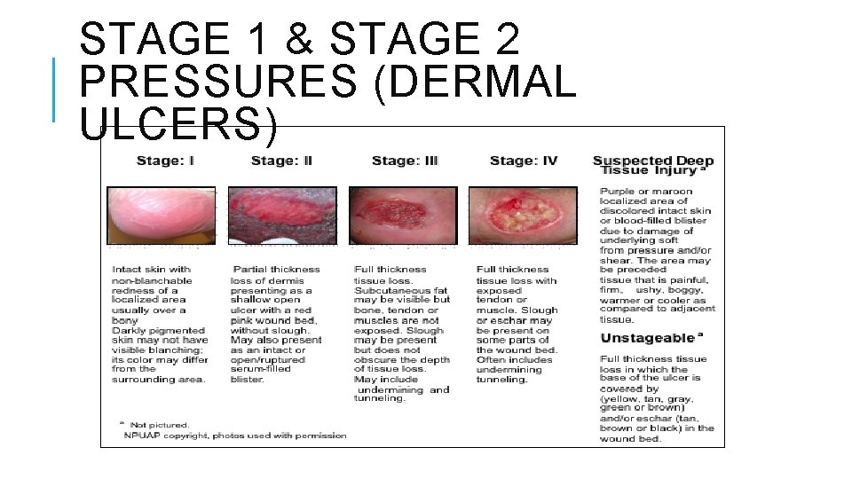 STAGE 1 & STAGE 2 PRESSURES (DERMAL ULCERS) STAGE 1 & STAGE 2 PRESSURES (DERMAL ULCERS)