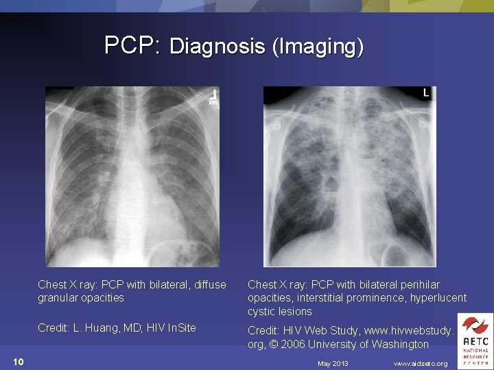 PCP: Diagnosis (Imaging) 10 Chest X ray: PCP with bilateral, diffuse granular opacities Chest